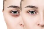Before and after using natural dark circles remover showing reduced puffiness and brightened under-eye area